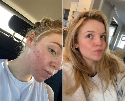 Skin Care acne prone skin cover photo collage