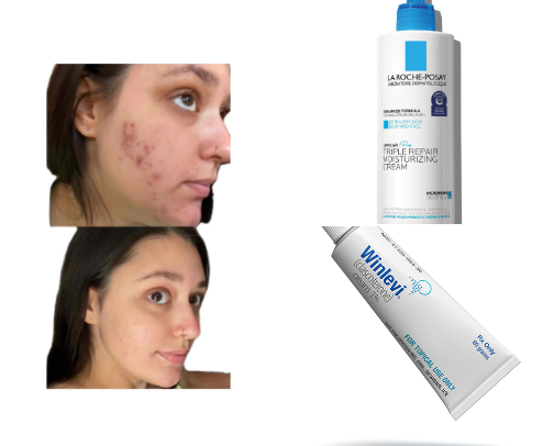 Skincare Routine That Cleared My Stubborn Acne 🫧 cover photo collage