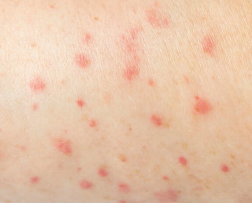 Chicken pox support cover photo collage