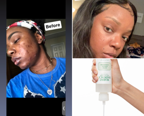 Acne MUST HAVES cover photo collage