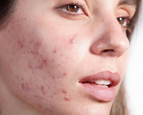 Acne Skin on Budget cover photo collage