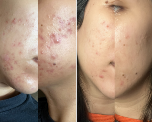 My Go-To Acne Skincare Picks cover photo collage