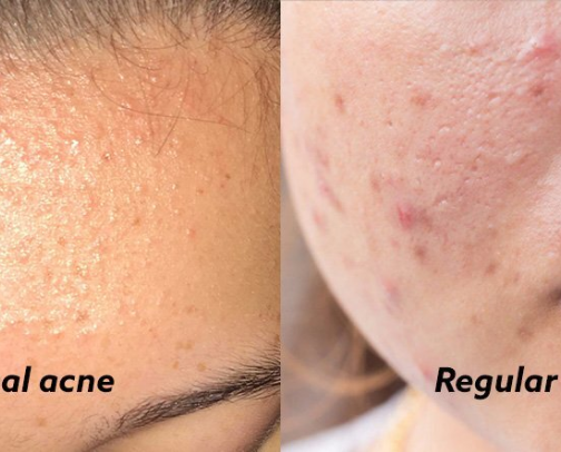 Best products for Acne prone skin cover photo collage