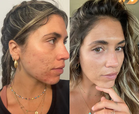 How I Fixed my Acne-prone Skin cover photo collage