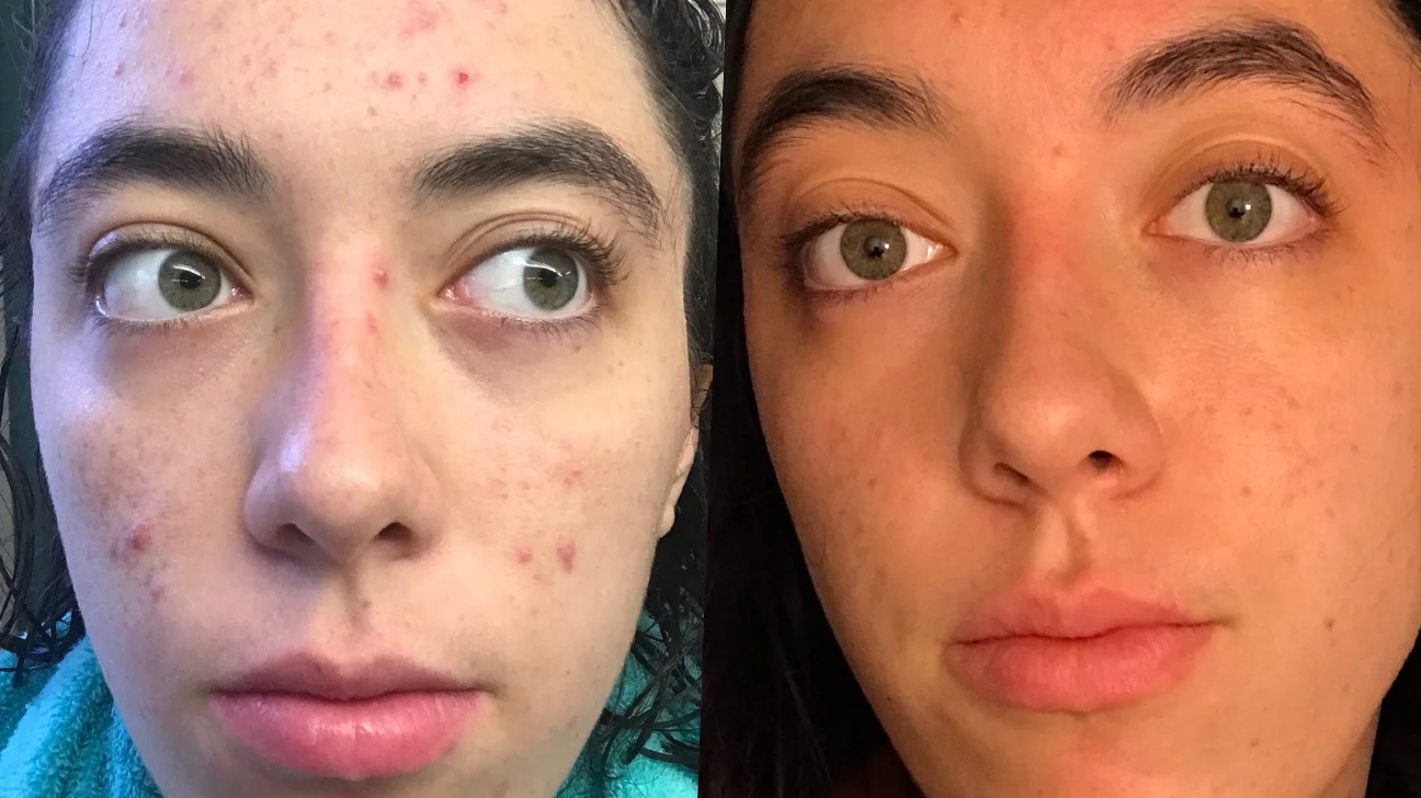 How I Got Acne-Free and STAYED Acne-Free cover photo collage