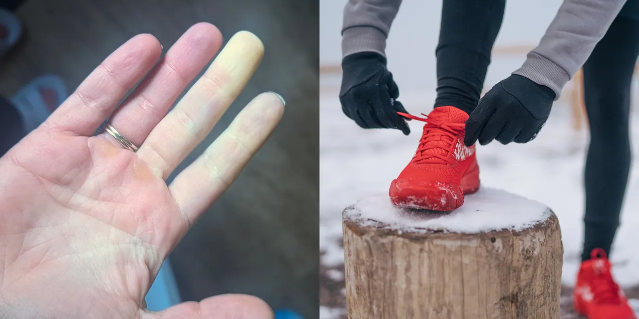 Raynaud’s Got You Blue (Fingered)? Relief to the Rescue! cover photo collage