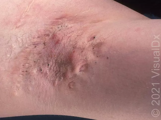 Suffering with HS? This list is for you! cover photo collage